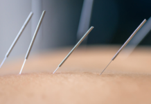 How Does Dry Needling Therapy Help Reduce Muscle Tension?