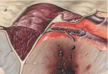 Healing with Expert Support: How a Colon Surgery Doctor Can Help You on Your Recovery Journey