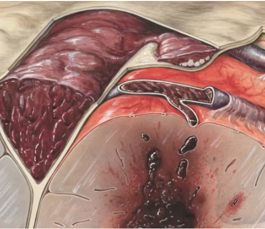 Healing with Expert Support: How a Colon Surgery Doctor Can Help You on Your Recovery Journey